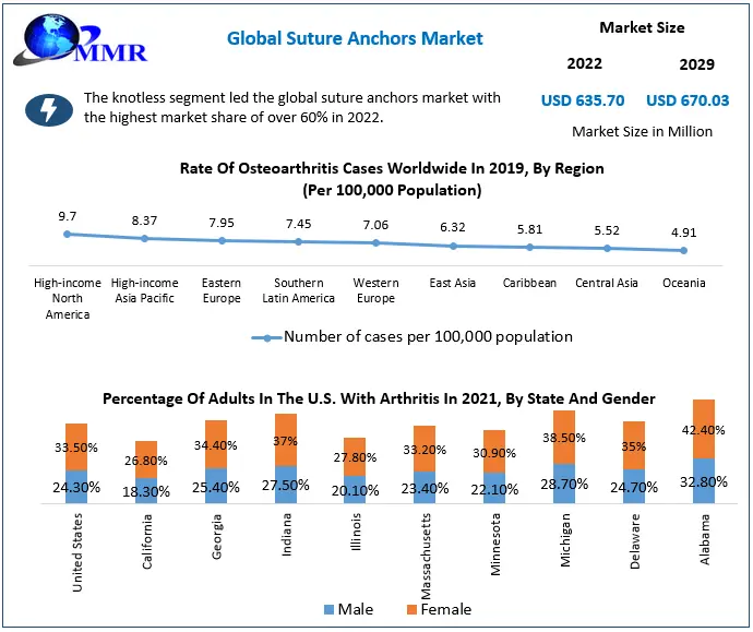 Suture Anchors Market: Global Industry Analysis and Forecast (2023-2029)